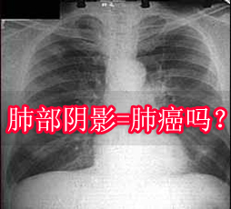 肺部ct是片子上看的清楚还是电脑上的影像看的清楚(图1)